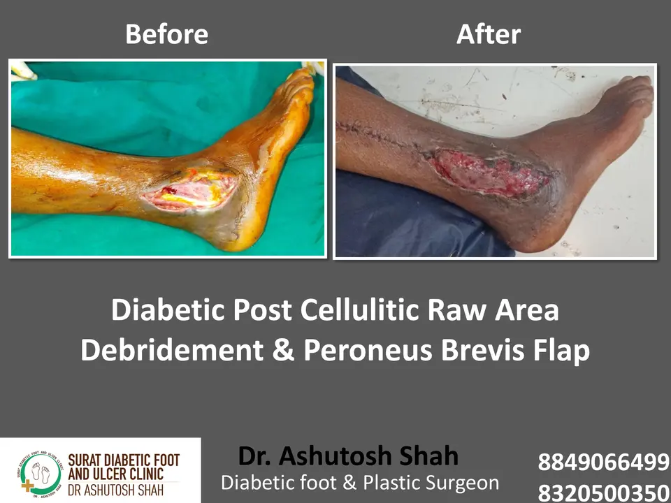 Diabetic Foot  PPT sunita.pptx-16.webp